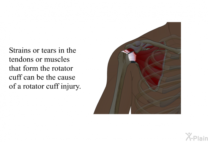 Strains or tears in the tendons or muscles that form the rotator cuff can be the cause of a rotator cuff injury.