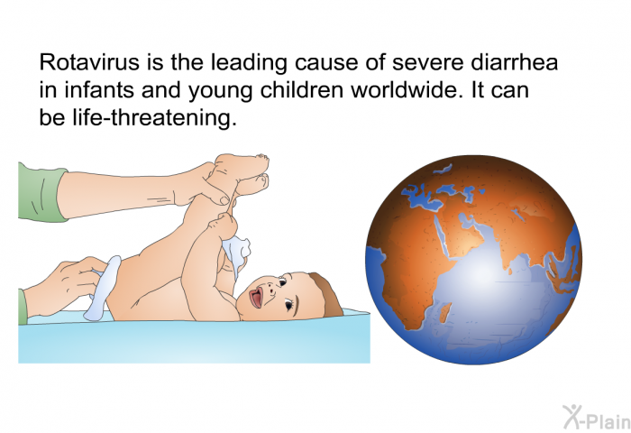 Rotavirus is the leading cause of severe diarrhea in infants and young children worldwide. It can be life-threatening.