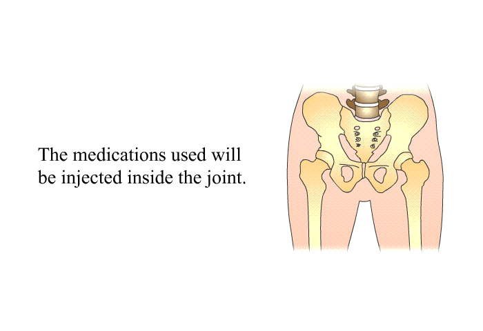 The medications used will be injected inside the joint.