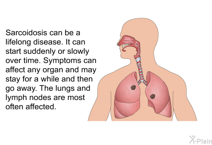 Sarcoidosis can be a lifelong disease. It can start suddenly or slowly over time. Symptoms can affect any organ and may stay for a while and then go away. The lungs and lymph nodes are most often affected.
