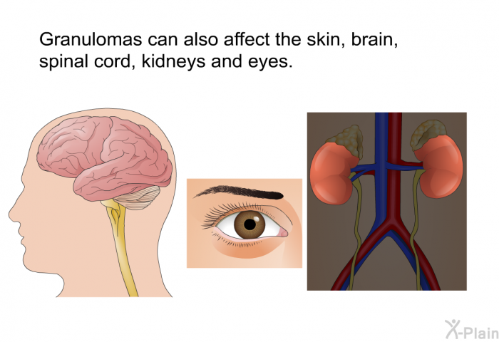 Granulomas can also affect the skin, brain, spinal cord, kidneys and eyes.