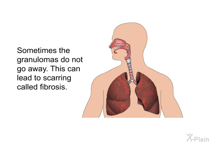 Sometimes the granulomas do not go away. This can lead to scarring called fibrosis.