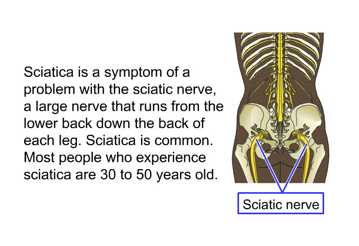 Sciatica is a symptom of a problem with the sciatic nerve, a large nerve that runs from the lower back down the back of each leg. Sciatica is common. Most people who experience sciatica are 30 to 50 years old.
