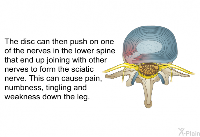 The disc can then push on one of the nerves in the lower spine that end up joining with other nerves to form the sciatic nerve. This can cause pain, numbness, tingling and weakness down the leg.