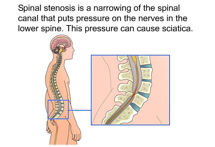 Spinal stenosis is a narrowing of the spinal canal that puts pressure on the nerves in the lower spine. This pressure can cause sciatica.