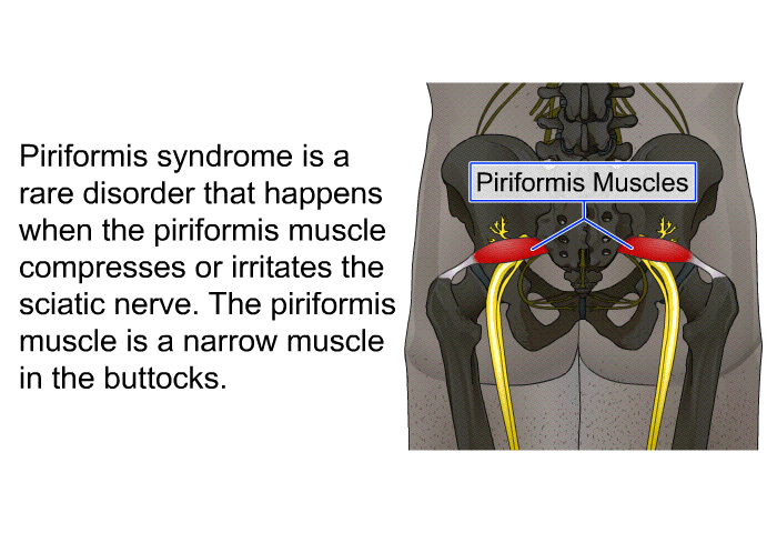 Piriformis syndrome is a rare disorder that happens when the piriformis muscle compresses or irritates the sciatic nerve. The piriformis muscle is a narrow muscle in the buttocks.