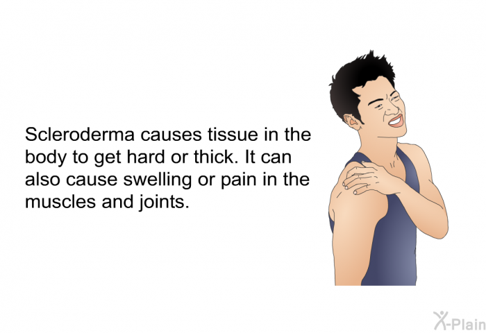 Scleroderma causes tissue in the body to get hard or thick. It can also cause swelling or pain in the muscles and joints.