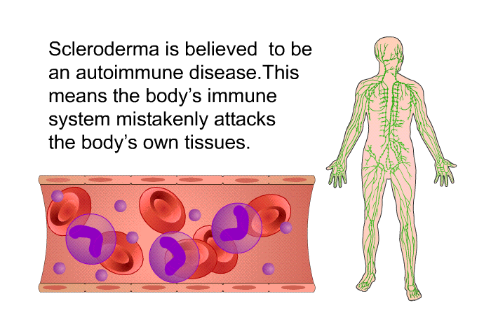 Scleroderma is believed to be an autoimmune disease. This means the body's immune system mistakenly attacks the body's own tissues.