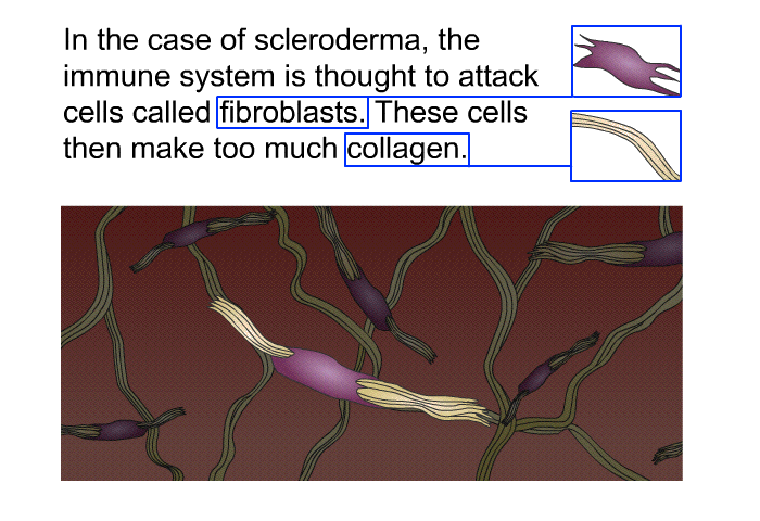 In the case of scleroderma, the immune system is thought to attack cells called fibroblasts. These cells then make too much collagen.