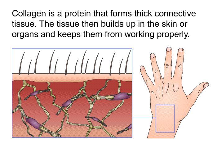 Collagen is a protein that forms thick connective tissue. The tissue then builds up in the skin or organs and keeps them from working properly.