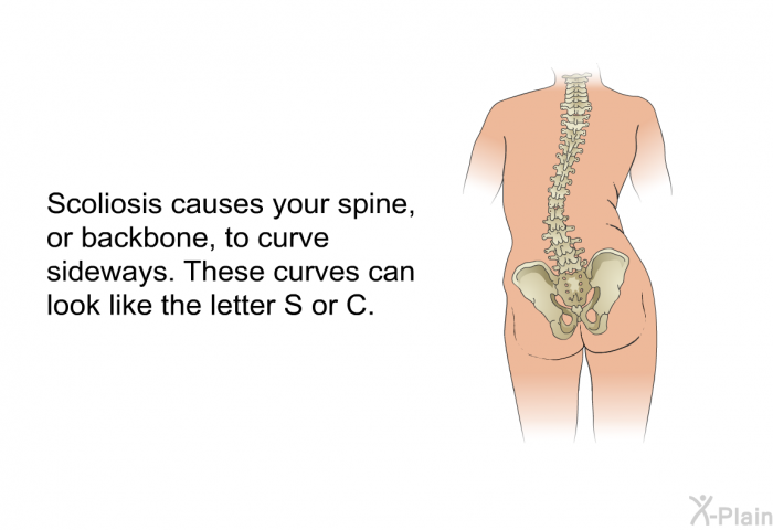 Scoliosis causes your spine, or backbone, to curve sideways. These curves can look like the letter S or C.