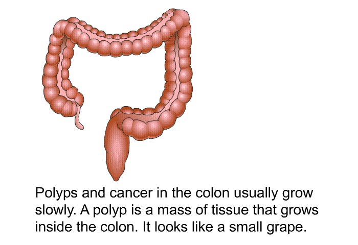 Polyps and cancer in the colon usually grow slowly. A polyp is a mass of tissue that grows inside the colon. It looks like a small grape.