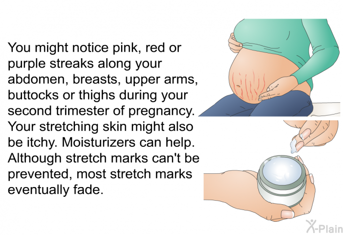 You might notice pink, red or purple streaks along your abdomen, breasts, upper arms, buttocks or thighs during your second trimester of pregnancy. Your stretching skin might also be itchy. Moisturizers can help. Although stretch marks can't be prevented, most stretch marks eventually fade.