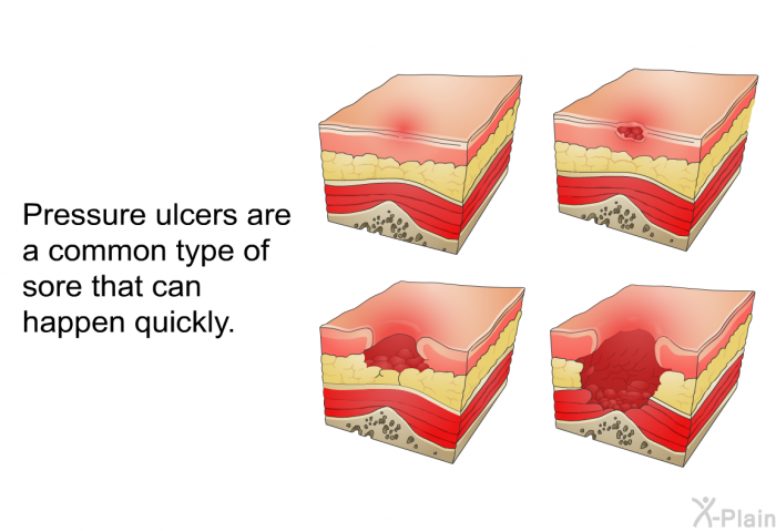 Pressure ulcers are a common type of sore that can happen quickly.