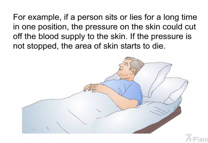 For example, if a person sits or lies for a long time in one position, the pressure on the skin could cut off the blood supply to the skin. If the pressure is not stopped, the area of skin starts to die.