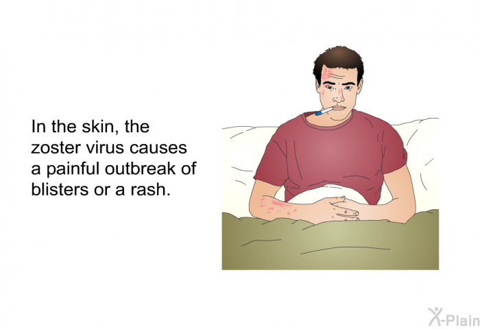 In the skin, the zoster virus causes a painful outbreak of blisters or a rash.