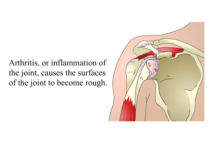 Arthritis, or inflammation of the joint, causes the surfaces of the joint to become rough.