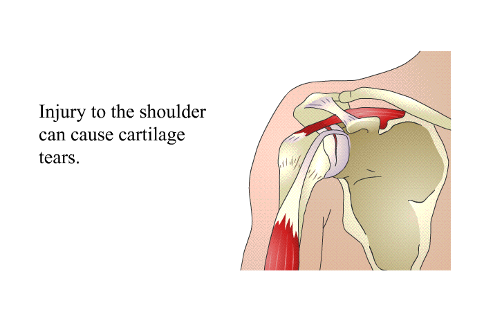 Injury to the shoulder can cause cartilage tears.