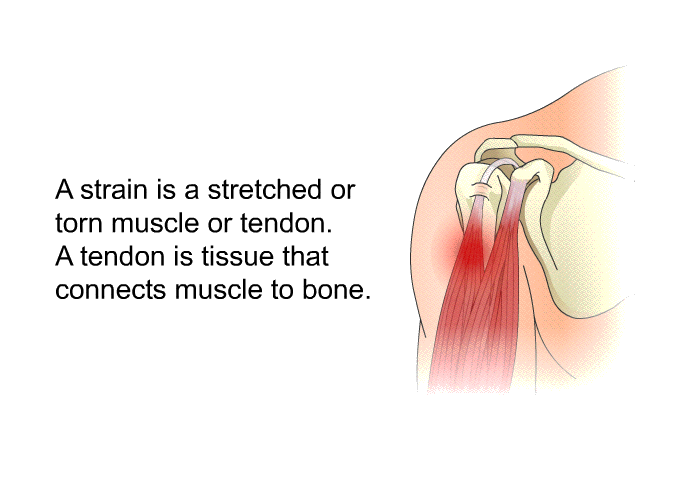 A strain is a stretched or torn muscle or tendon. A tendon is tissue that connects muscle to bone.