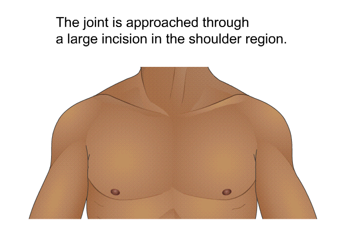 The joint is approached through a large incision in the shoulder region.