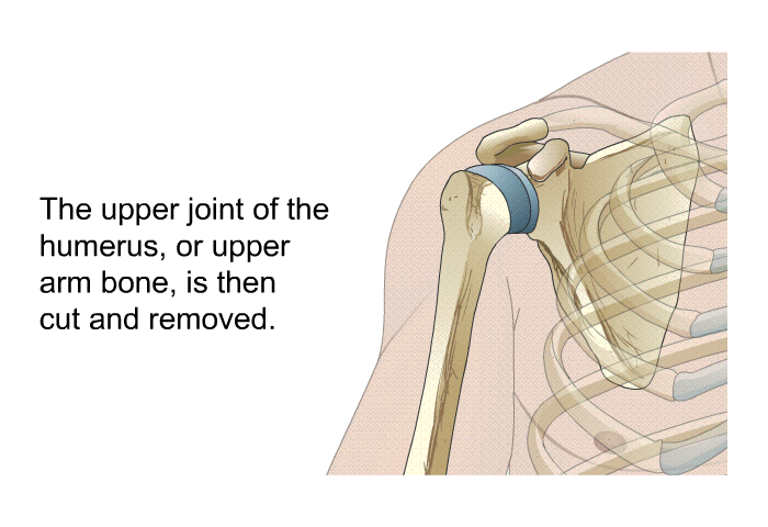 The upper joint of the humerus, or upper arm bone, is then cut and removed.