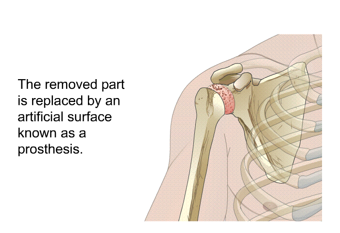 The removed part is replaced by an artificial surface known as a prosthesis.