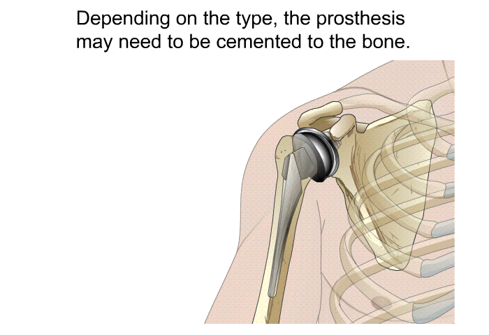 Depending on the type, the prosthesis may need to be cemented to the bone.