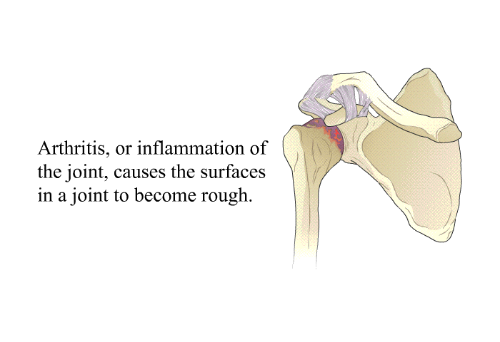Arthritis, or inflammation of the joint, causes the surfaces in a joint to become rough.