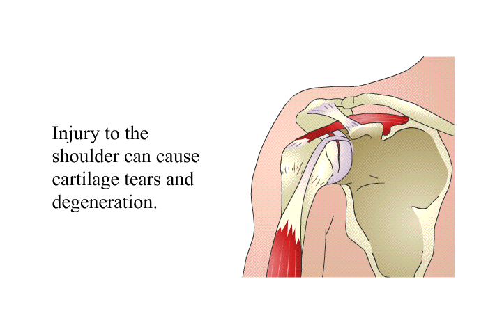 Injury to the shoulder can cause cartilage tears and degeneration.