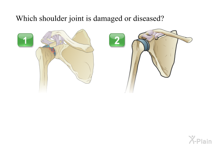 Which shoulder joint is damaged or diseased?