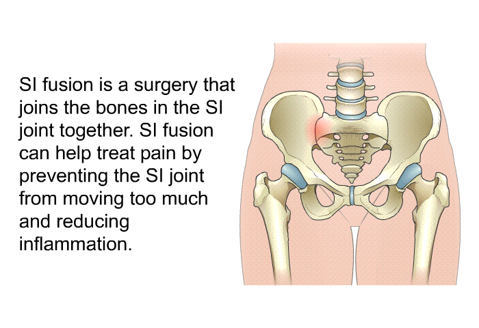 SI fusion is a surgery that joins the bones in the SI joint together. SI fusion can help treat pain by preventing the SI joint from moving too much and reducing inflammation.