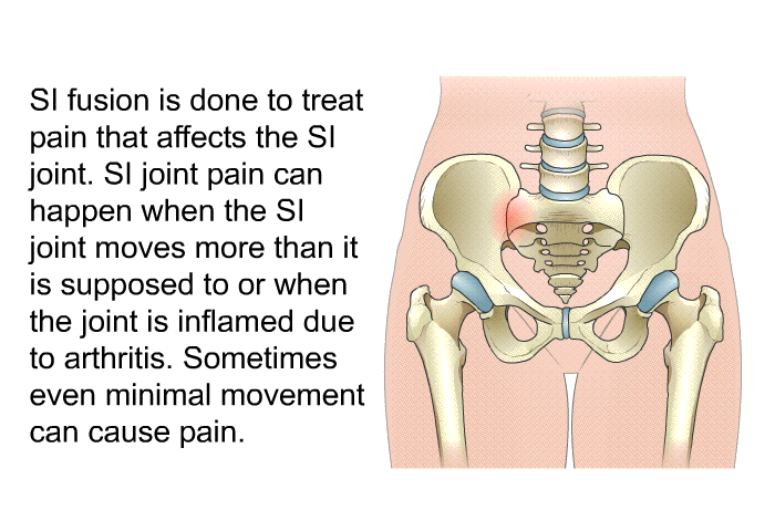 SI fusion is done to treat pain that affects the SI joint. SI joint pain can happen when the SI joint moves more than it is supposed to or when the joint is inflamed due to arthritis. Sometimes even minimal movement can cause pain.