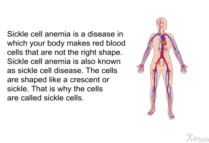 Sickle cell anemia is a disease in which your body makes red blood cells that are not the right shape. Sickle cell anemia is also known as sickle cell disease. The cells are shaped like a crescent or sickle. That is why the cells are called sickle cells.