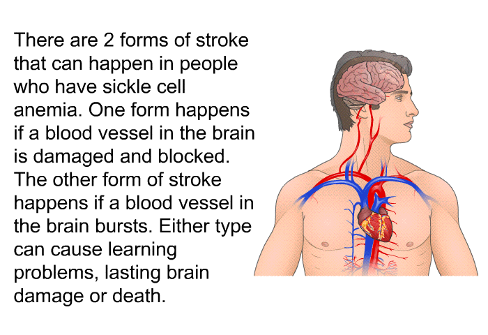 There are 2 forms of stroke that can happen in people who have sickle cell anemia. One form happens if a blood vessel in the brain is damaged and blocked. The other form of stroke happens if a blood vessel in the brain bursts. Either type can cause learning problems, lasting brain damage or death.