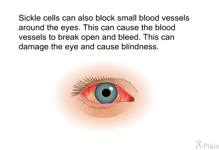 Sickle cells can also block small blood vessels around the eyes. This can cause the blood vessels to break open and bleed. This can damage the eye and cause blindness.