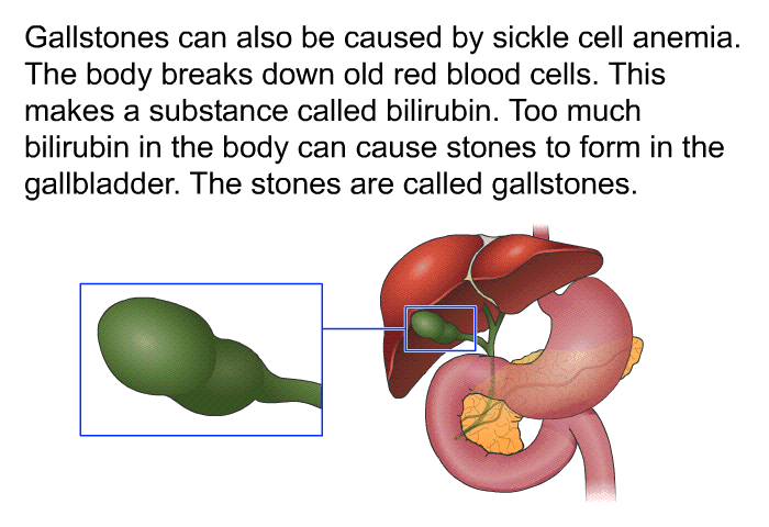 Gallstones can also be caused by sickle cell anemia. The body breaks down old red blood cells. This makes a substance called bilirubin. Too much bilirubin in the body can cause stones to form in the gallbladder. The stones are called gallstones.
