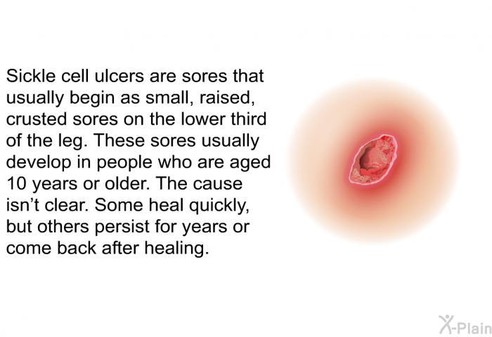 Sickle cell ulcers are sores that usually begin as small, raised, crusted sores on the lower third of the leg. These sores usually develop in people who are aged 10 years or older. The cause isn't clear. Some heal quickly, but others persist for years or come back after healing.