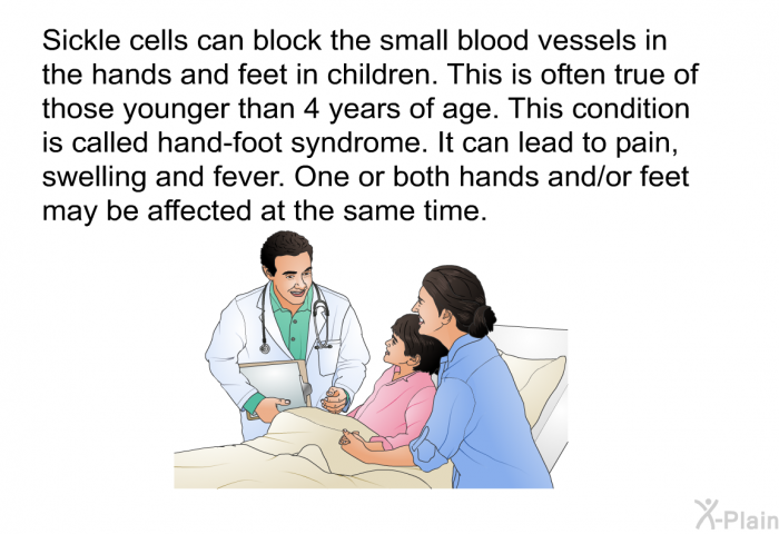Sickle cells can block the small blood vessels in the hands and feet in children. This is often true of those younger than 4 years of age. This condition is called hand-foot syndrome. It can lead to pain, swelling and fever. One or both hands and/or feet may be affected at the same time.