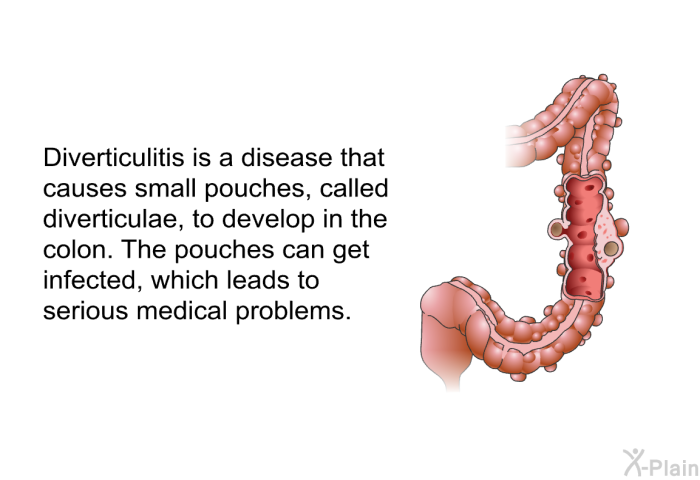 Diverticulitis is a disease that causes small pouches, called diverticula, to develop in the colon. The pouches can get infected, which leads to serious medical problems.