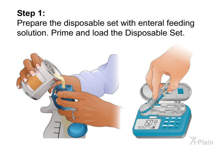 <B>Step 1:</B> 
Prepare the disposable set with enteral feeding solution. Prime and load the Disposable Set.