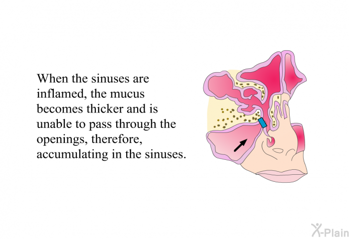 When the sinuses are inflamed, the mucus becomes thicker and is unable to pass through the openings, therefore, accumulating in the sinuses.