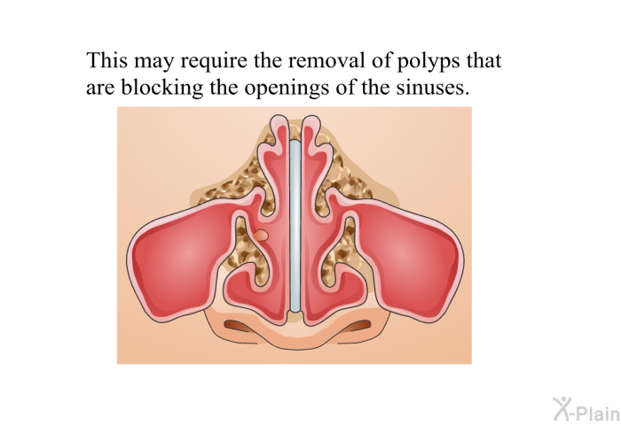 This may require the removal of polyps that are blocking the openings of the sinuses.