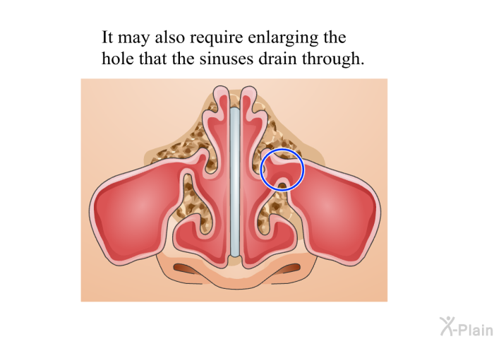 It may also require enlarging the hole that the sinuses drain through.