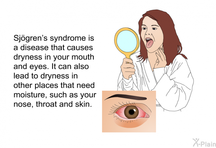 Sjögren's syndrome is a disease that causes dryness in your mouth and eyes. It can also lead to dryness in other places that need moisture, such as your nose, throat and skin.
