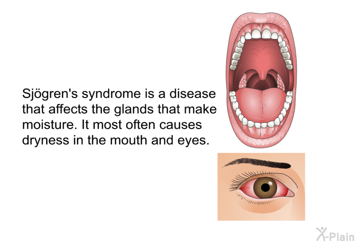 Sjögren's syndrome is a disease that affects the glands that make moisture. It most often causes dryness in the mouth and eyes.