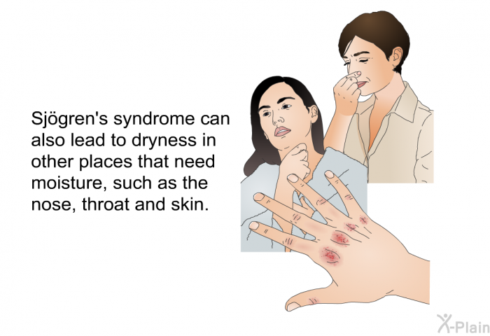 Sjögren's syndrome can also lead to dryness in other places that need moisture, such as the nose, throat and skin.