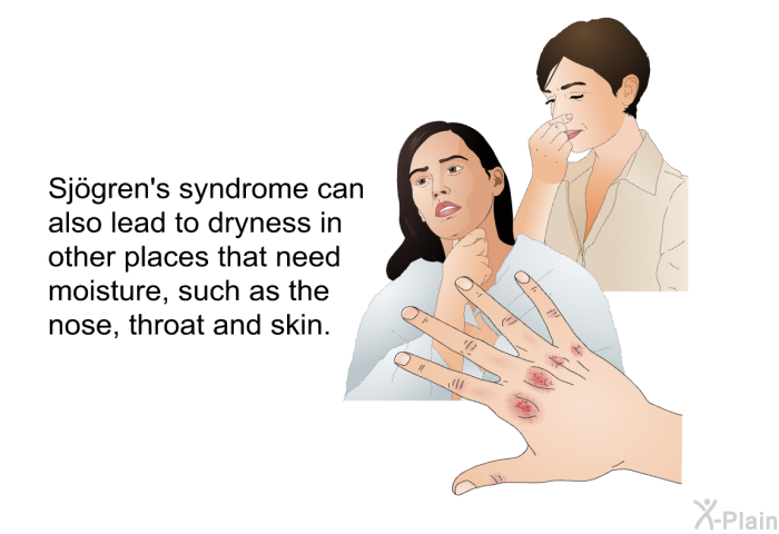 Sjögren's syndrome can also lead to dryness in other places that need moisture, such as the nose, throat and skin.