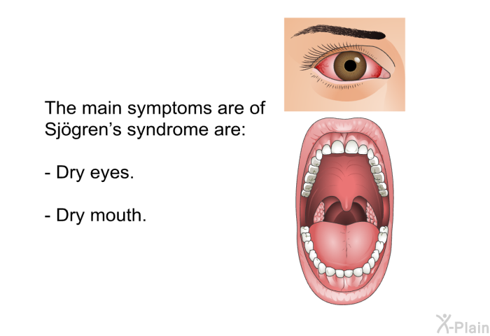 The main symptoms are of Sjögren's syndrome are:  Dry eyes. Dry mouth.