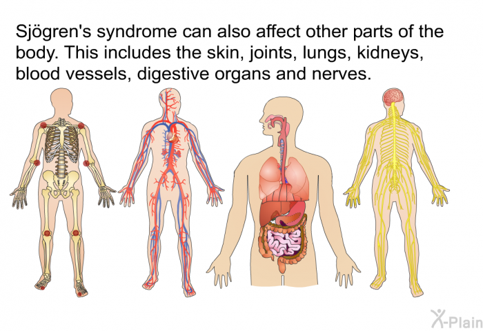 Sjögren's syndrome can also affect other parts of the body. This includes the skin, joints, lungs, kidneys, blood vessels, digestive organs and nerves.