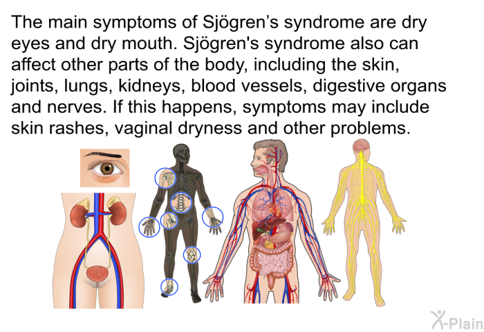 The main symptoms of Sj&ouml;gren's syndrome are dry eyes and dry mouth. Sj&ouml;gren's syndrome also can affect other parts of the body, including the skin, joints, lungs, kidneys, blood vessels, digestive organs and nerves. If this happens, symptoms may include skin rashes, vaginal dryness and other problems.